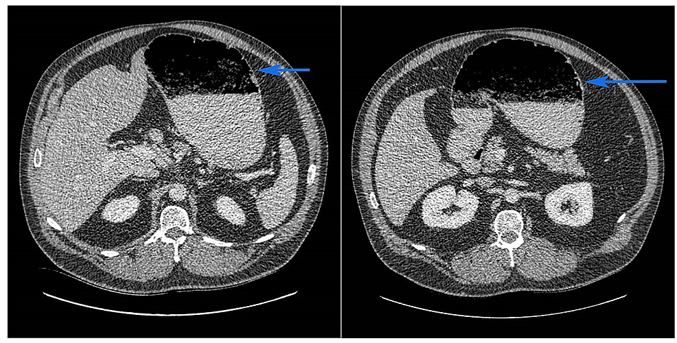 gastroparesis glp 1 Liraglutide-induced Acute Gastroparesis