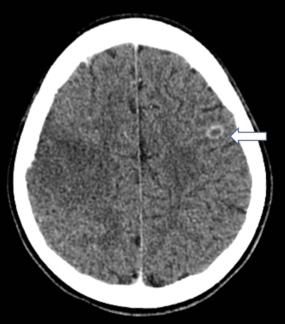 Cureus Invasive CommunityAcquired MethicillinResistant Staphylococcus aureus (MRSA