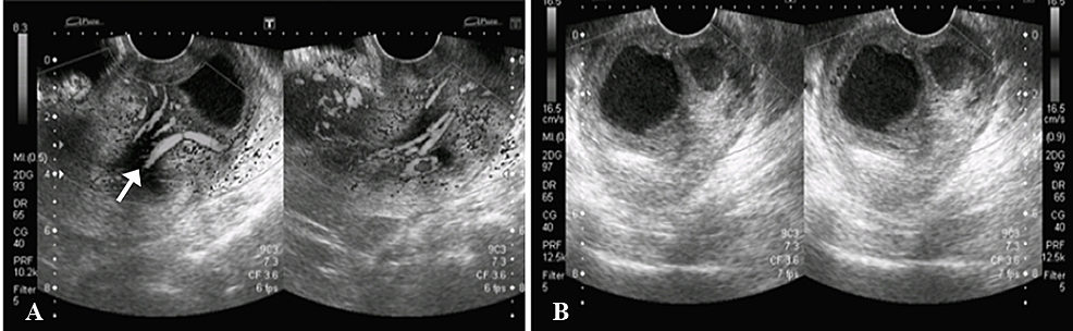 Transvaginal-ultrasound-images.
