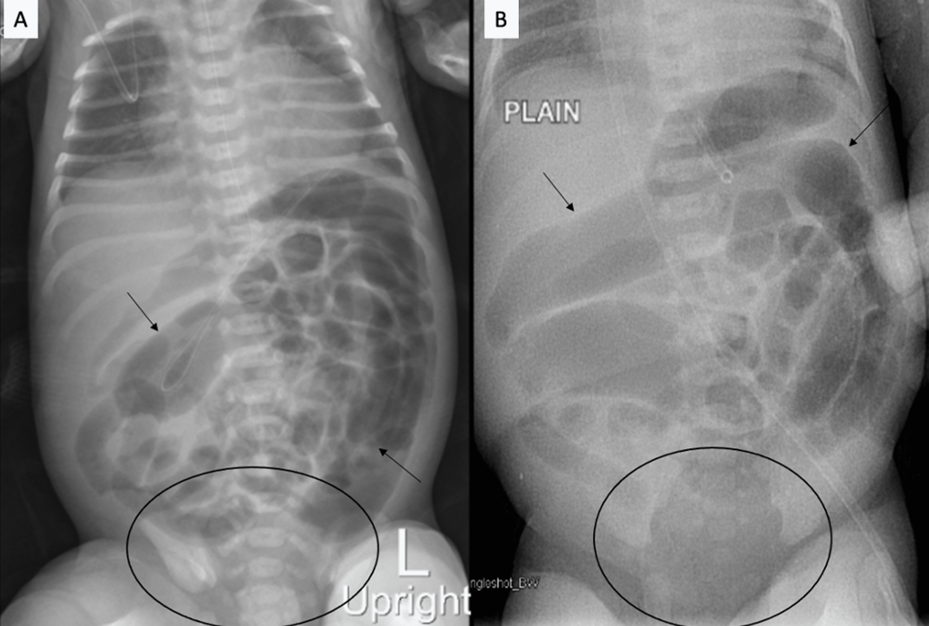 Windsock or Cobra Head Sign A Distinctive Imaging Sign to