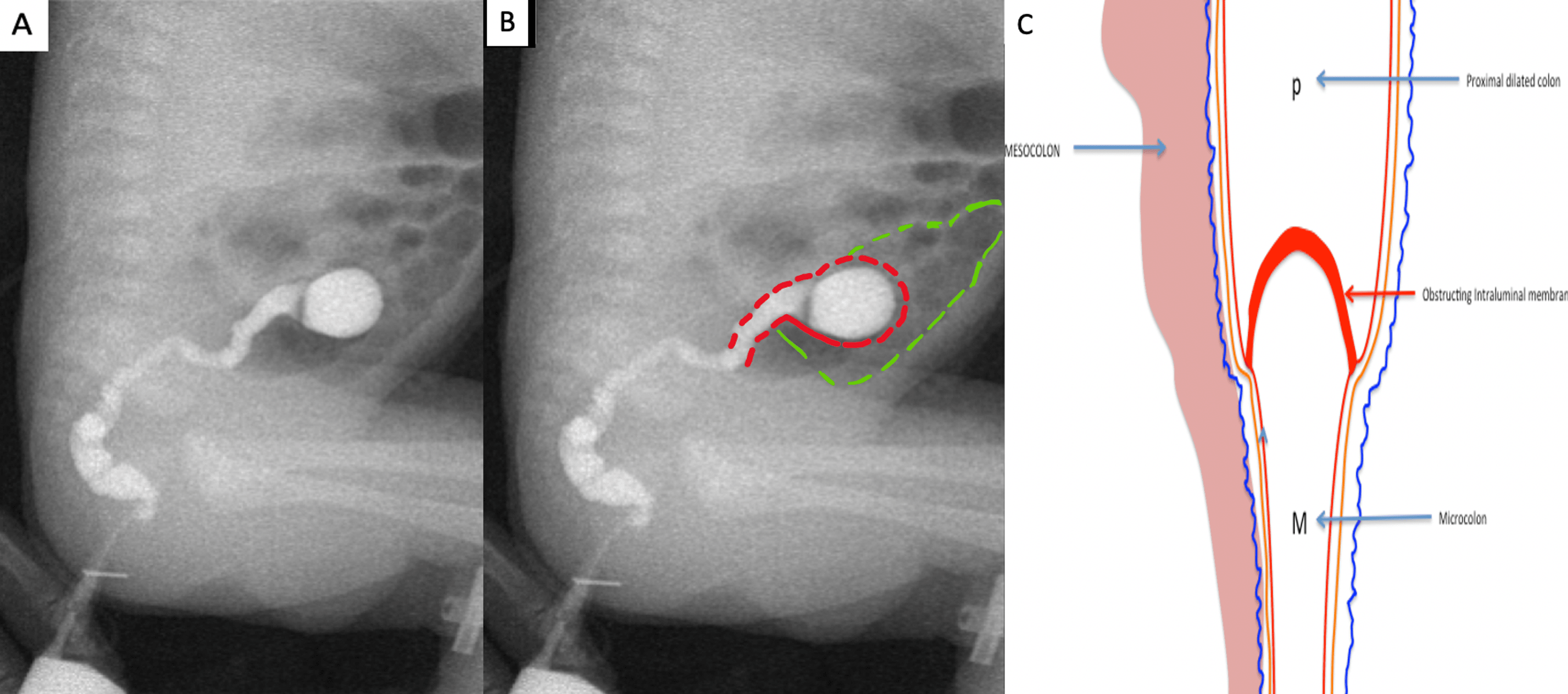 Cureus Windsock or Cobra Head Sign A Distinctive Imaging Sign to