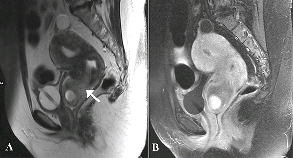 Magnetic-resonance-images---A)-Sagittal-T2-weighted-and-B)-Sagittal-T1-post-contrast.
