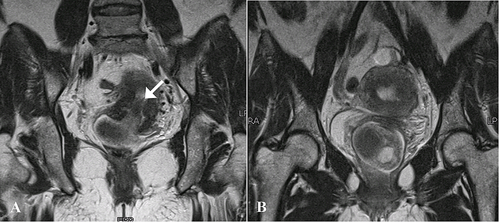Magnetic-resonance-images---Coronal-T2-weighted-sequences.