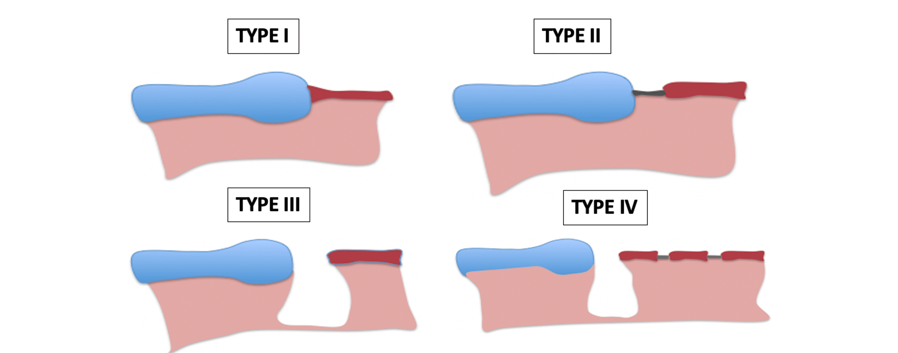 Windsock or Cobra Head Sign A Distinctive Imaging Sign to