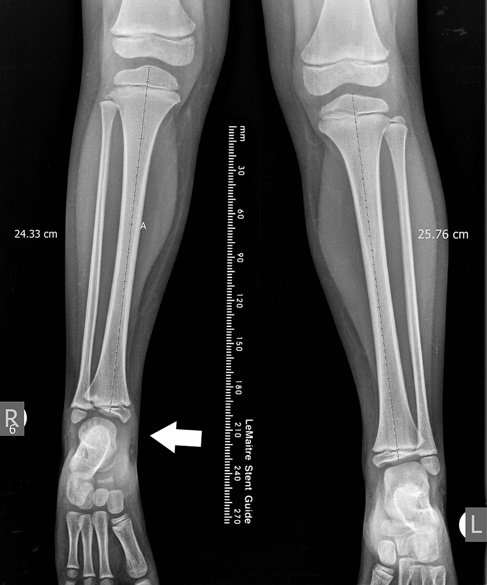 Foot Oligodactyly As The Main Dysplasia In Children | Cureus