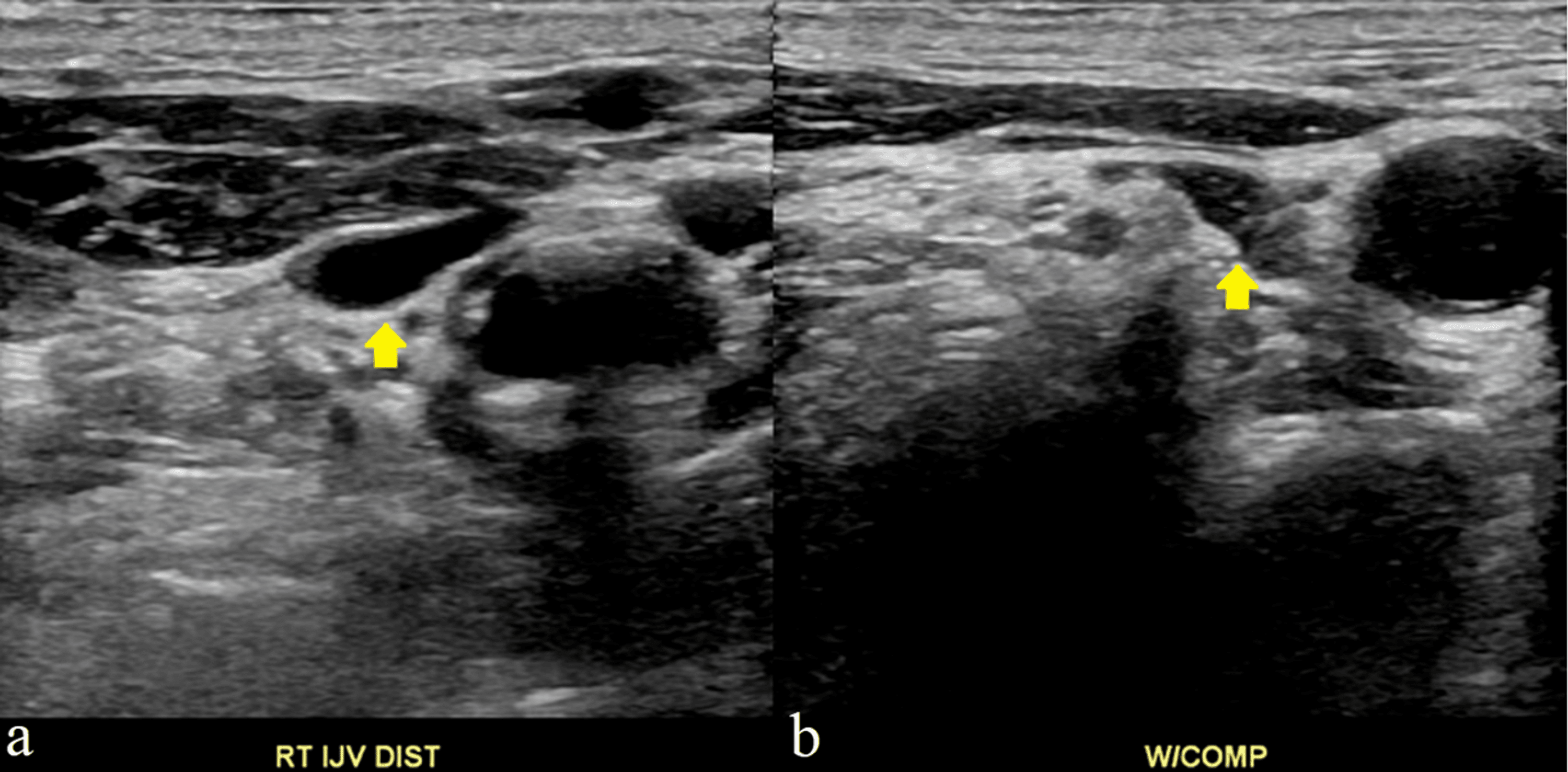 Cureus Superficial Venous Thrombosis of the Brachial Vein With
