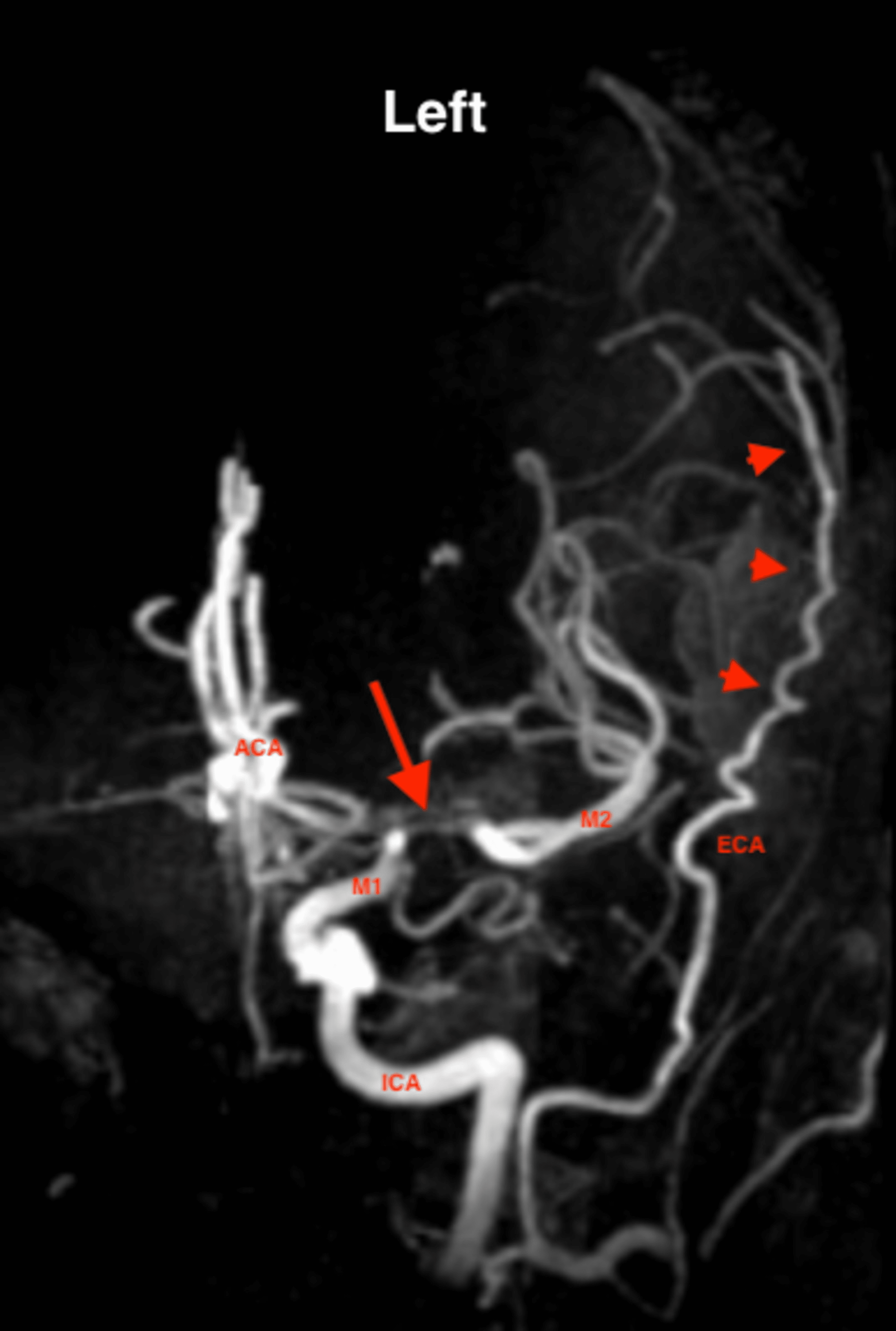 Cureus Moyamoya Syndrome (MMS) in a Patient With Sickle Cell Disease