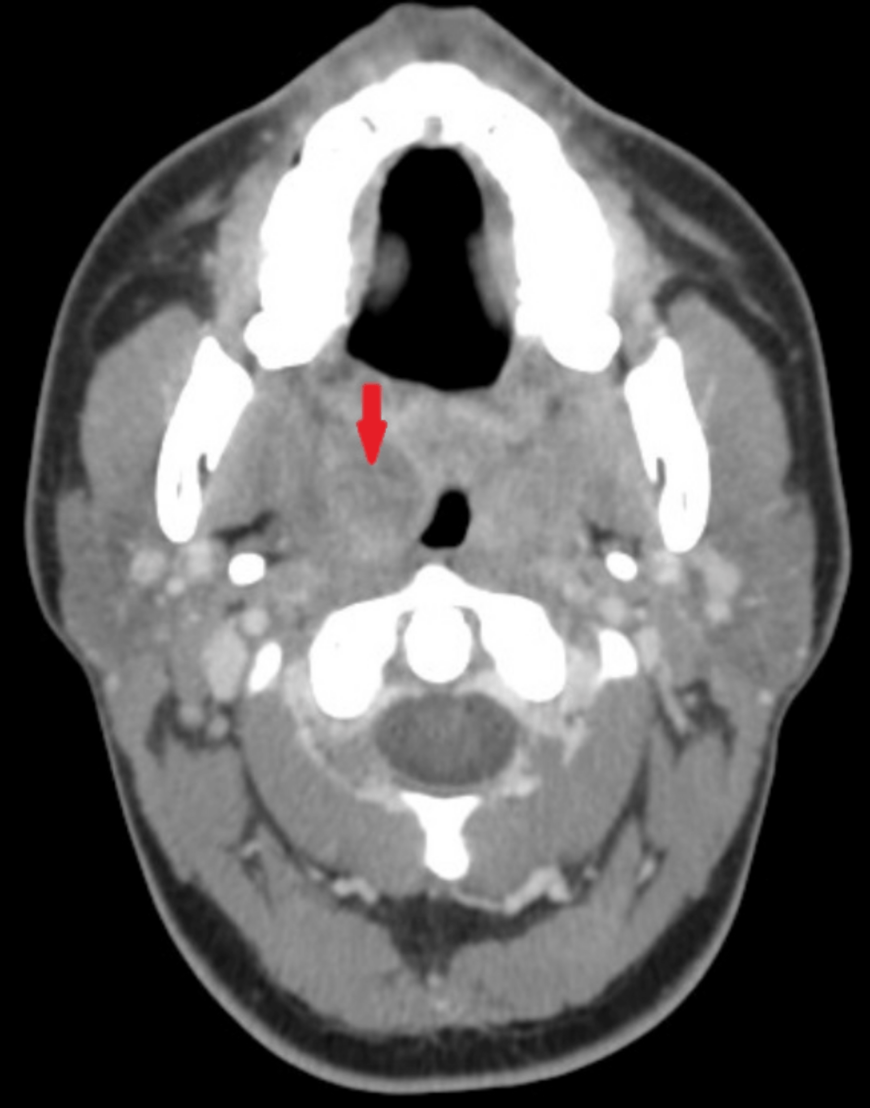 Cureus Are Computed Tomography Scans Necessary for the Diagnosis of Peritonsillar Abscess?