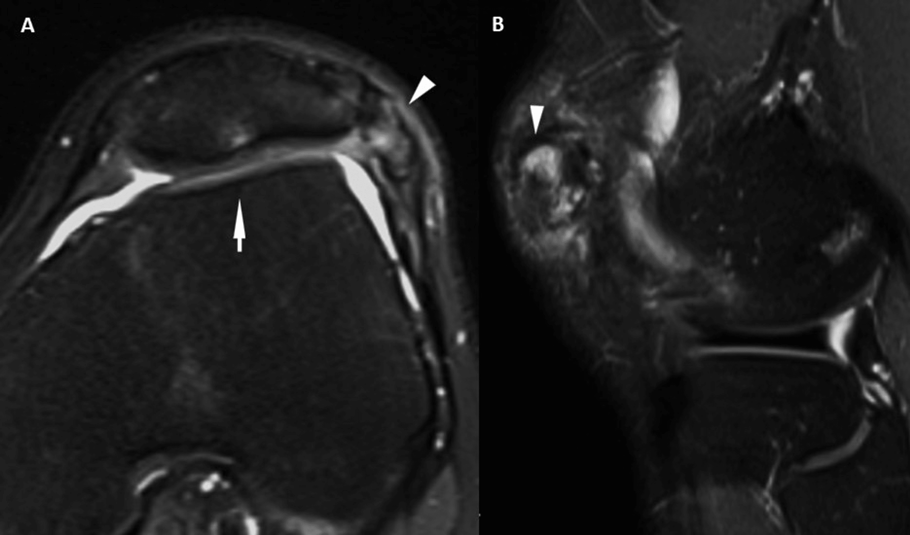 Cureus | The Effect Of Patellofemoral Maltracking And Patella Type On ...