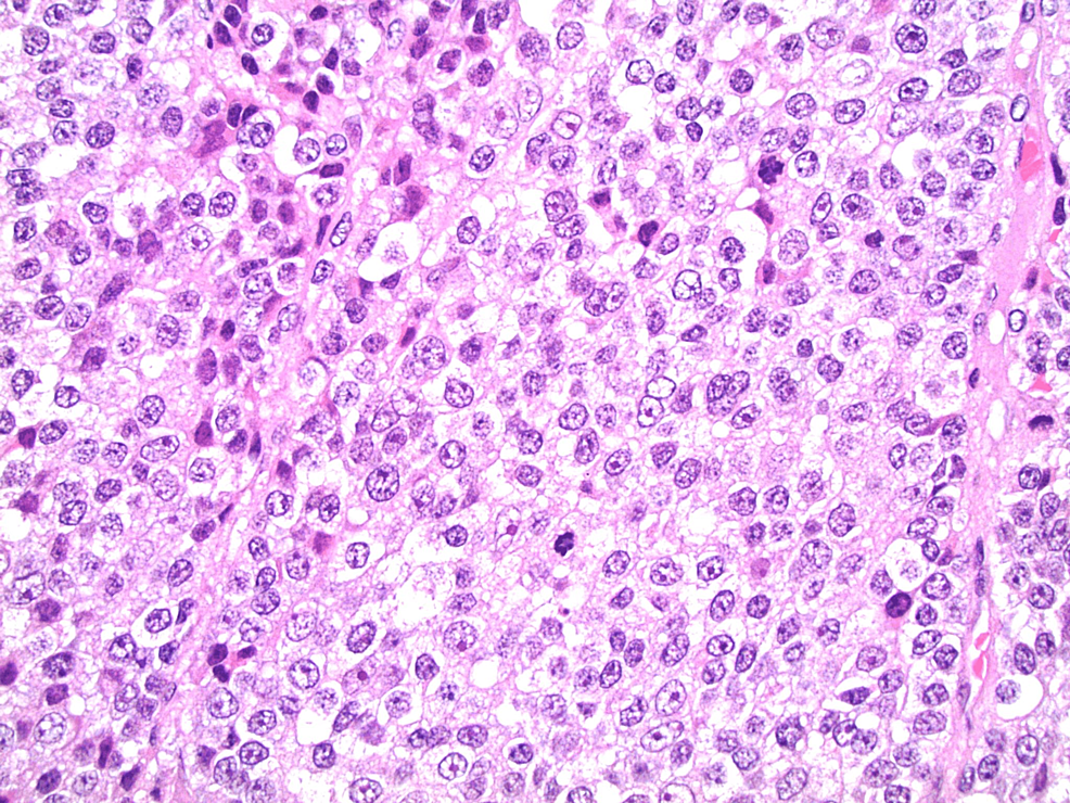 Hematoxylin-&-eosin-stain-of-a-section-of-tissue-from-pathologic-biopsy-under-high-power-microscopy.-Noted-are-the-increased-number-of-mitotic-figures,-increased-nuclear:cytoplasmic-ratio,-and-abnormal-mitotic-figures-typical-for-a-high-grade-malignancy,