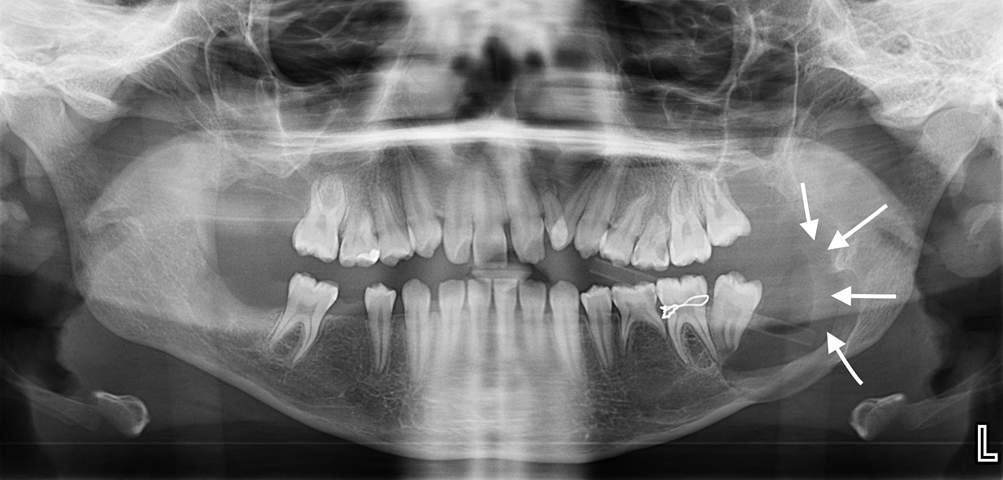 Cureus | Gorlin-Goltz Syndrome: A Case Report and Literature Review