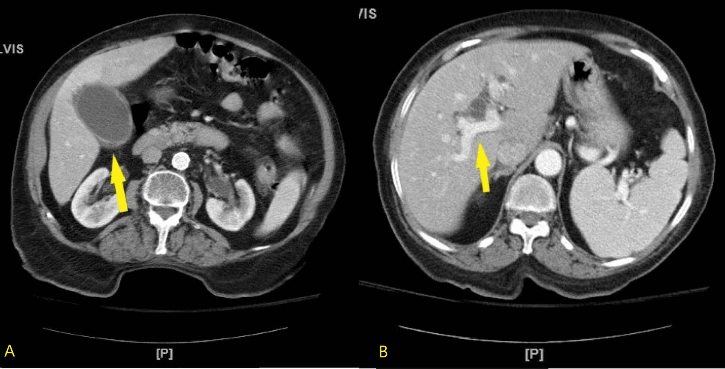 Cureus Endoscopic Treatment of Acute Cholelithiasis Using AXIOS Stenting and Lithotripsy A
