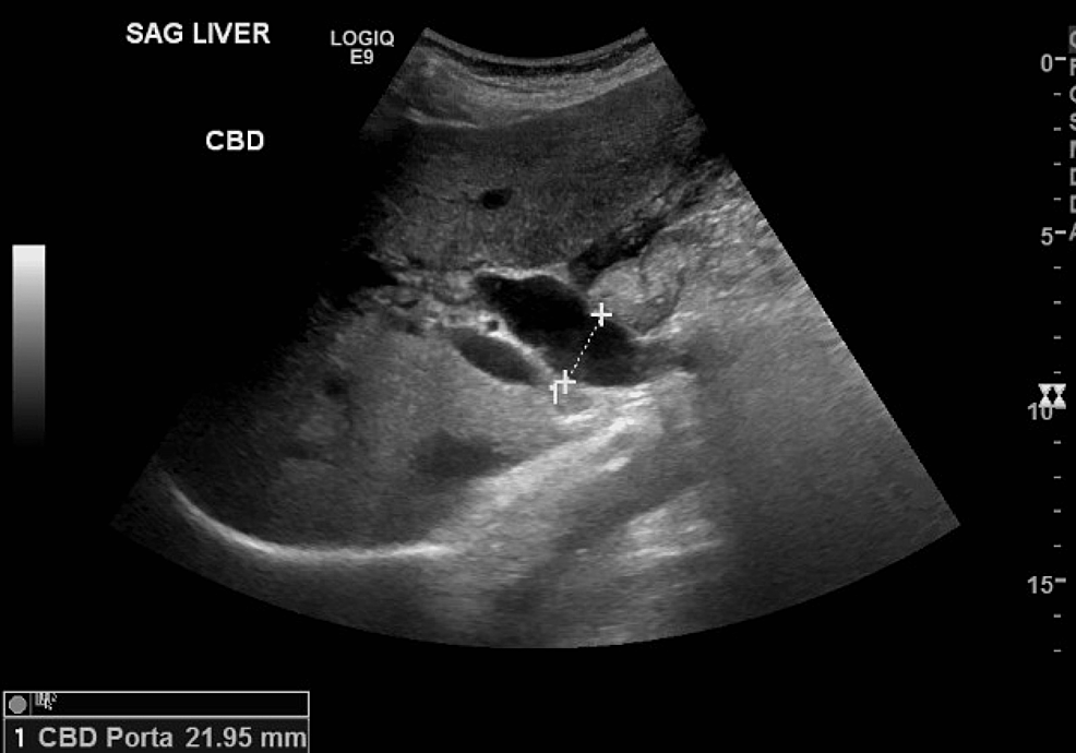 Cureus Endoscopic Treatment of Acute Cholelithiasis Using AXIOS Stenting and Lithotripsy A
