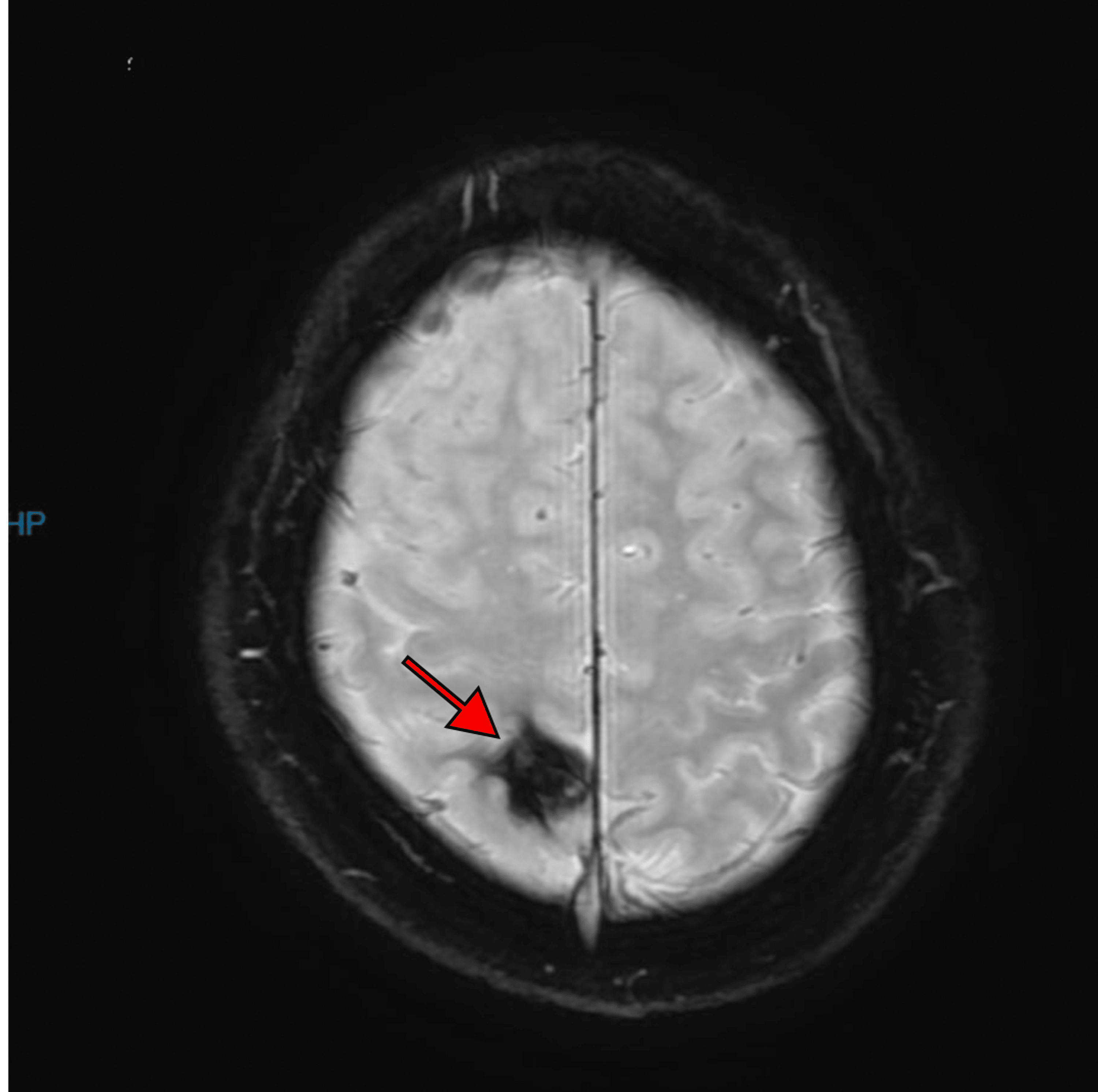 Cureus Behavioral Seizure in a Patient With a Cavernous Malformation