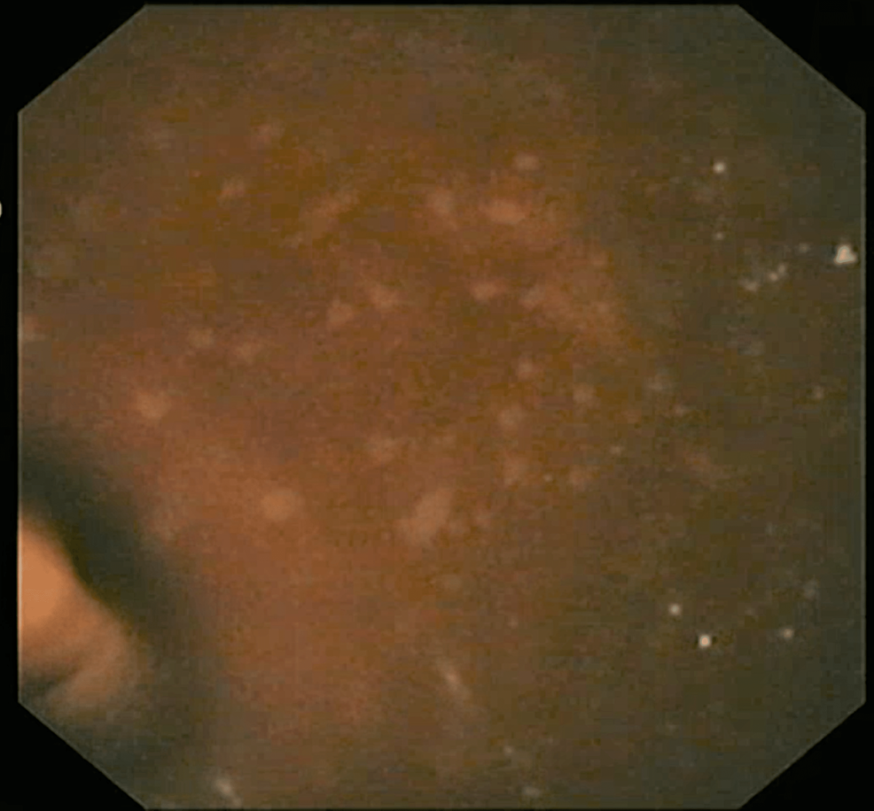 melanotic mucosa in the entire colon SciELO Brasil main image 1