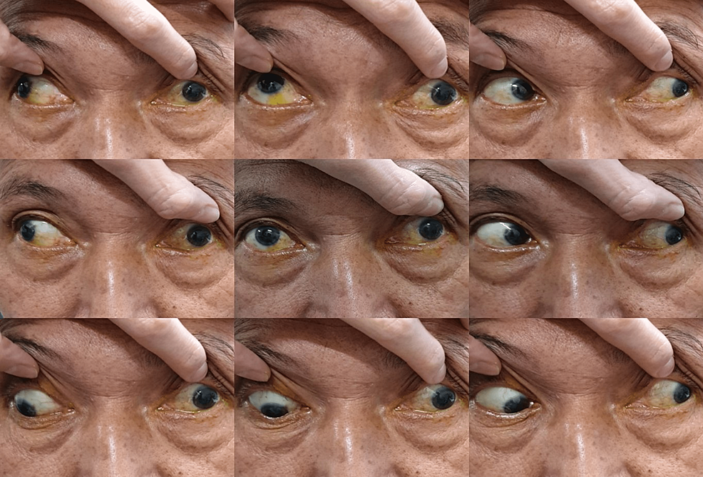 Sixth Nerve Palsy Case Based Neuro Ophthalmology vrogue.co