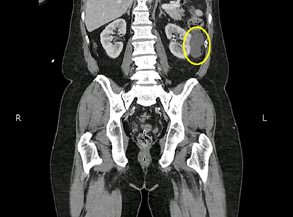 ovarian-cancer-ct-scan-with-contrast