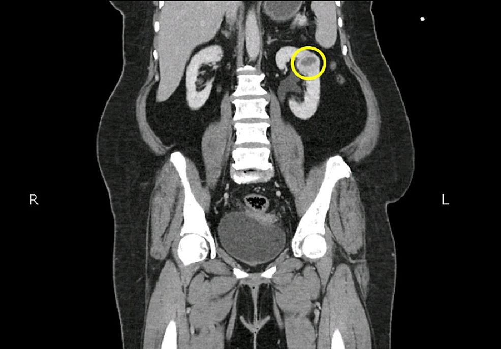 Pelvic Ct Scan