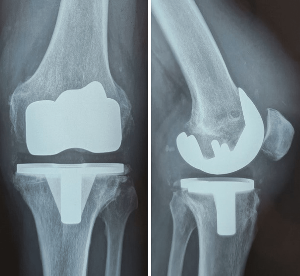 Cureus AboveKnee Amputation After Total Knee Replacement Infection The Unfortunate End of an