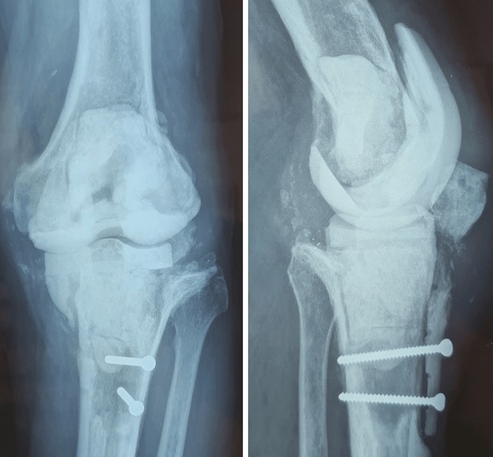 Cureus AboveKnee Amputation After Total Knee Replacement Infection