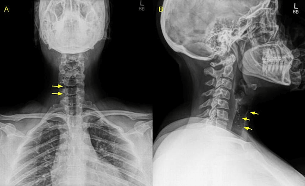 Diagnosis and Management of a Hypersensitivity Reaction to Titanium