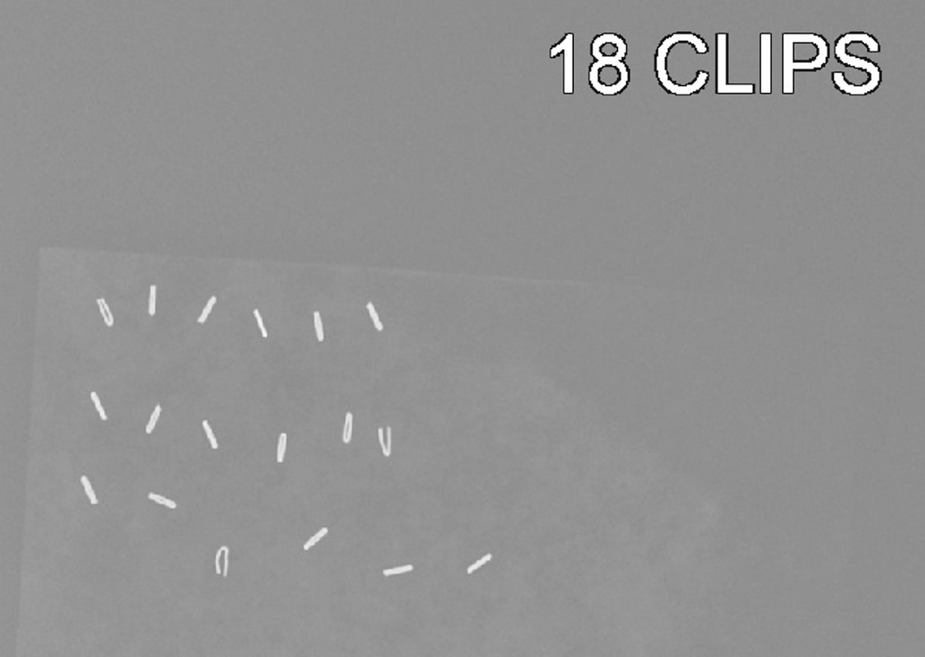 Cureus Diagnosis and Management of a Hypersensitivity Reaction to