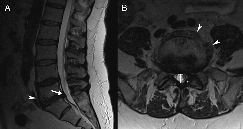 Cureus Improvement of Anorgasmia and Anejaculation After Spinal