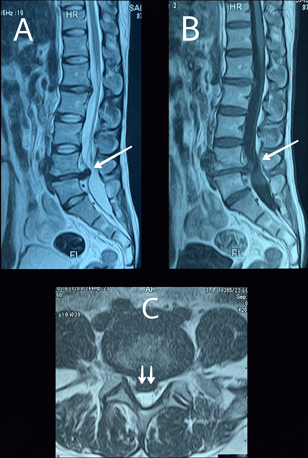 Cureus Herniating Intradural Disc At Lumbar L4 L5 Level A Case Report