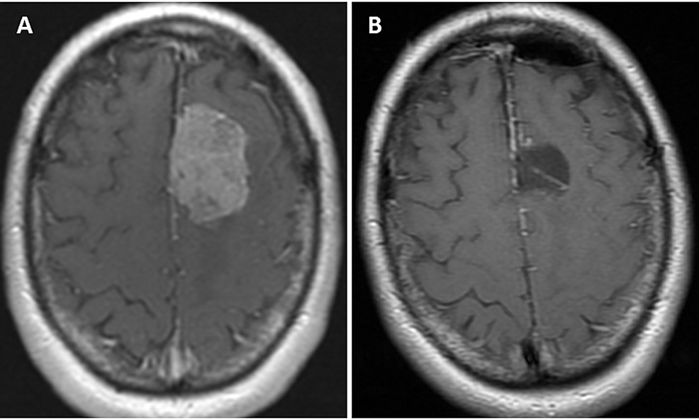 Management Of Intracranial Meningiomas Using Keyhole Techniques | Cureus