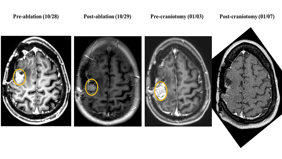 Cureus Persistent PeriAblation BloodBrain Barrier Opening After