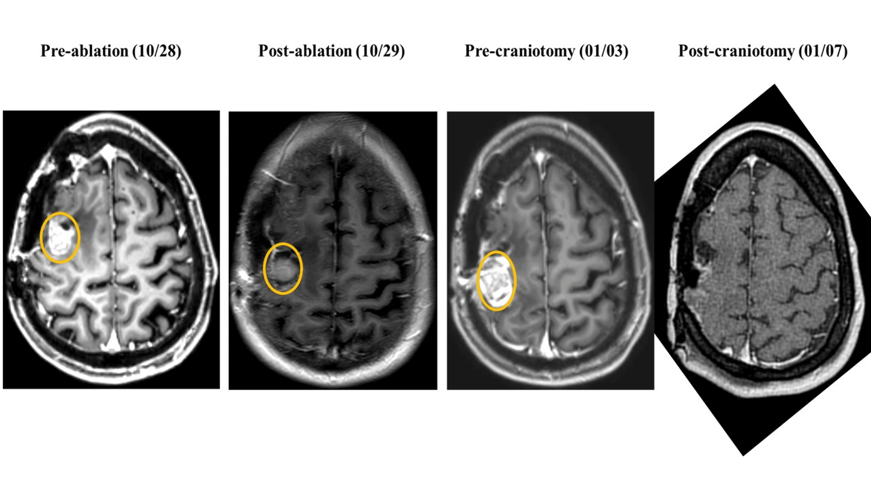 Cureus Persistent PeriAblation BloodBrain Barrier Opening After