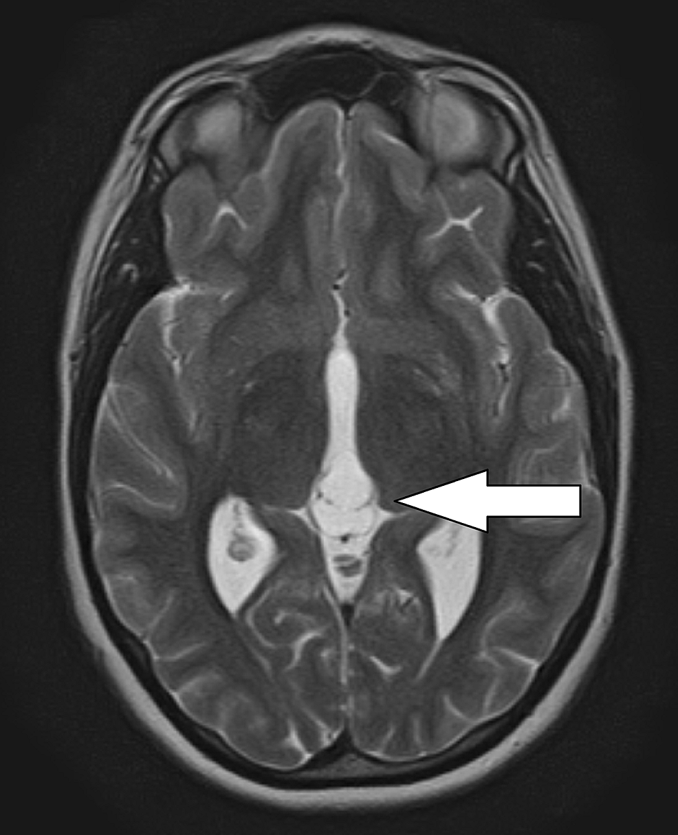 Cureus | Idiopathic Intracranial Hypertension Masking as Obstructive ...