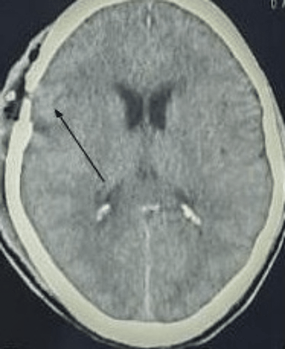 cureus-non-traumatic-chronic-subdural-hematoma-with-myelodysplastic