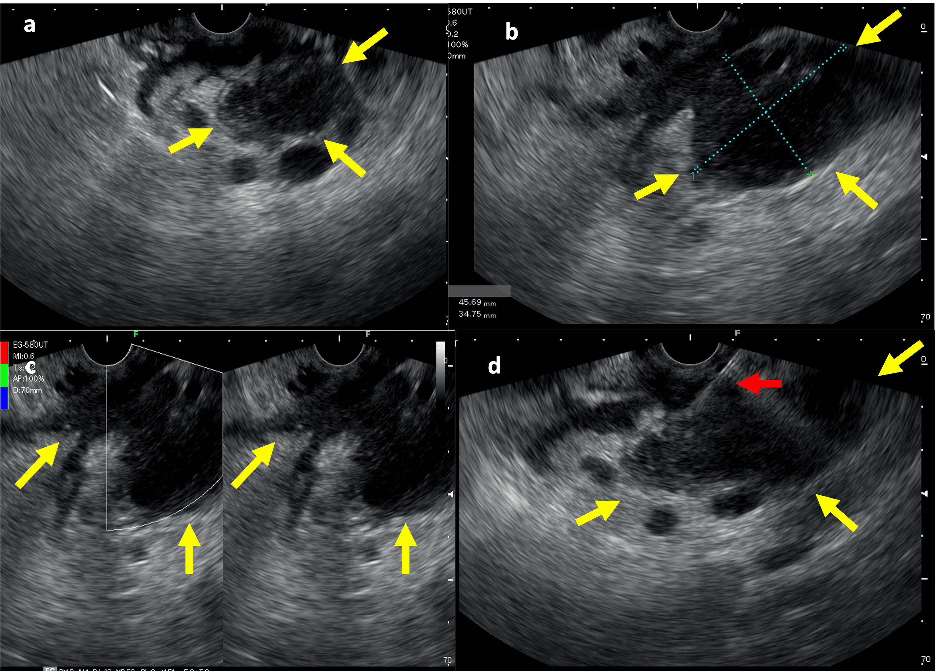 Cureus Primary Pancreatic Lymphoma EndosonographyGuided Tissue