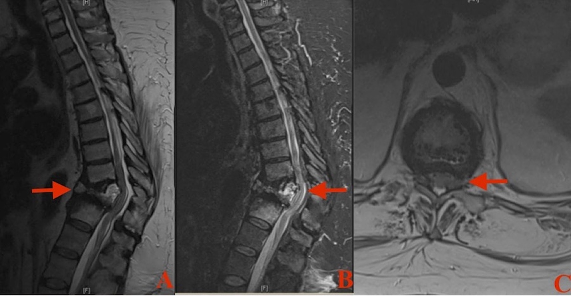 Cureus Duplication Of Vertebral Pedicles Associated With A Thoracic Burst Fracture Resulting In Spinal Cord Compression A Case Report