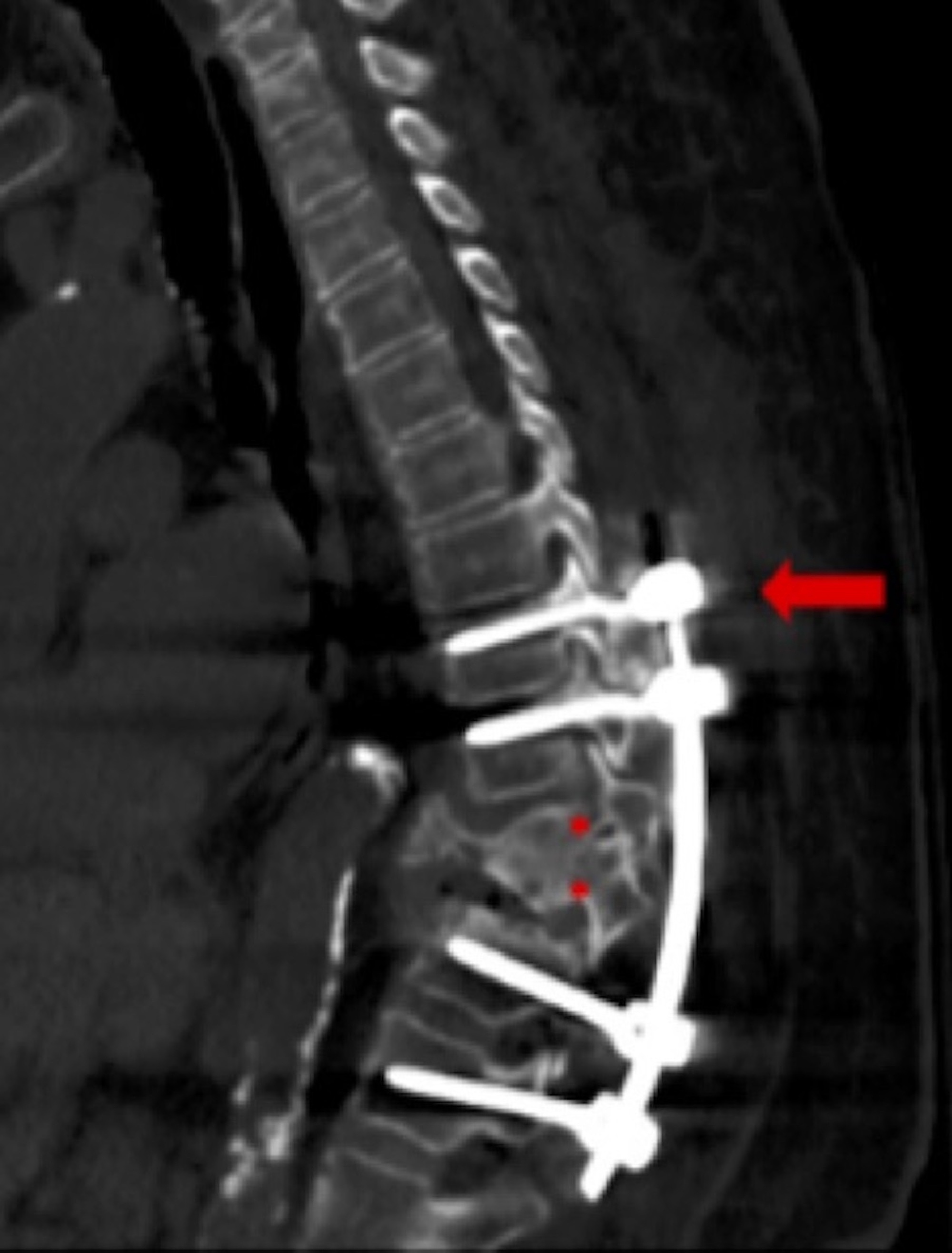 Duplication Of Vertebral Pedicles Associated With A Thoracic Burst Fracture Resulting In Spinal Cord Compression A Case Report Cureus