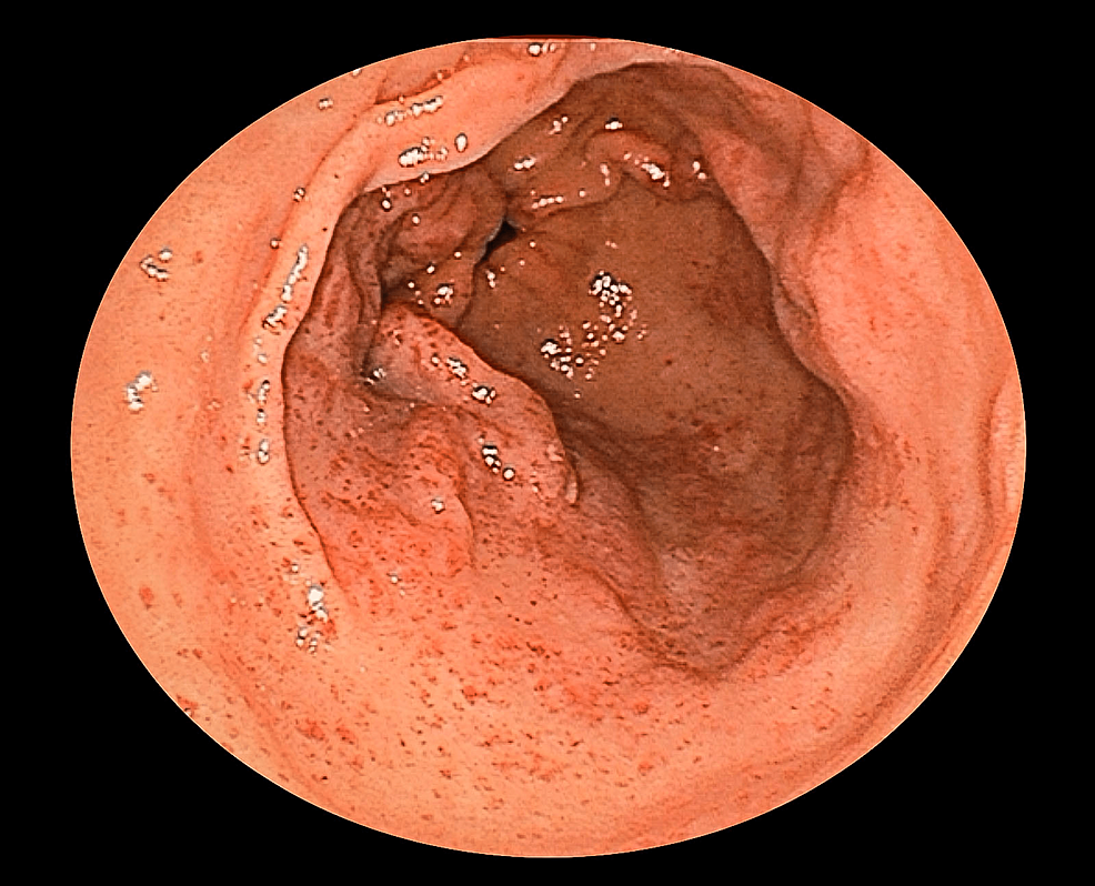 Cureus A Case of Refractory Gastric Antral Vascular Ectasia Treated