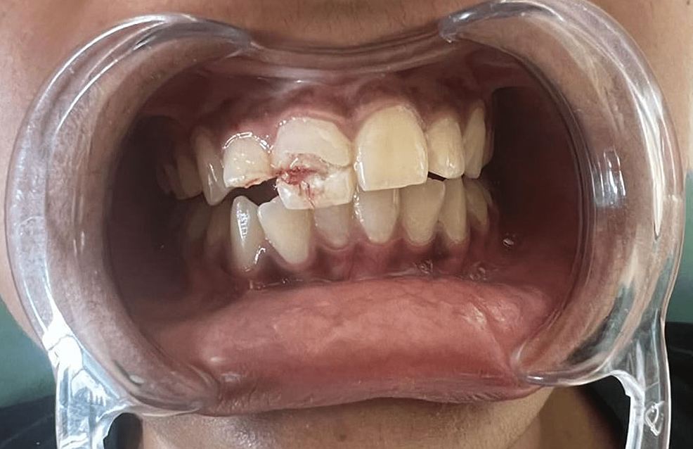 Cureus Management of Complex Crown Fractures A Case Series