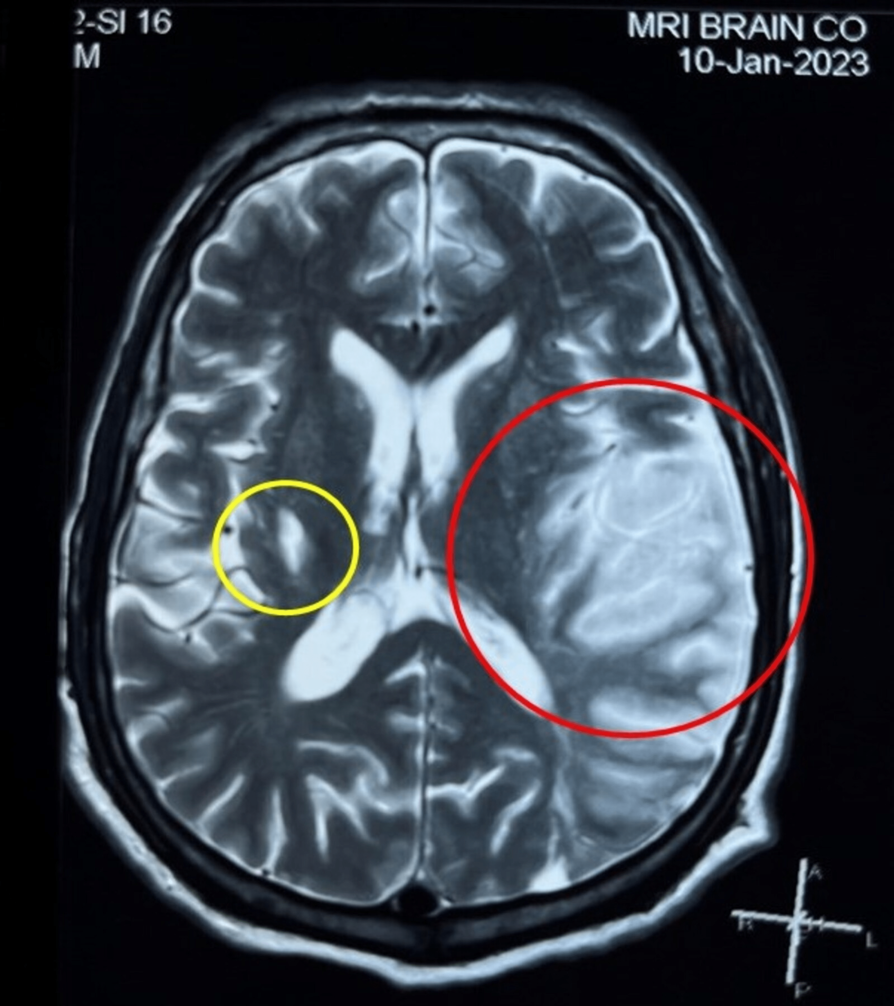 Cureus | Recurrent Strokes in a Patient With Metastatic Lung Cancer |  Article