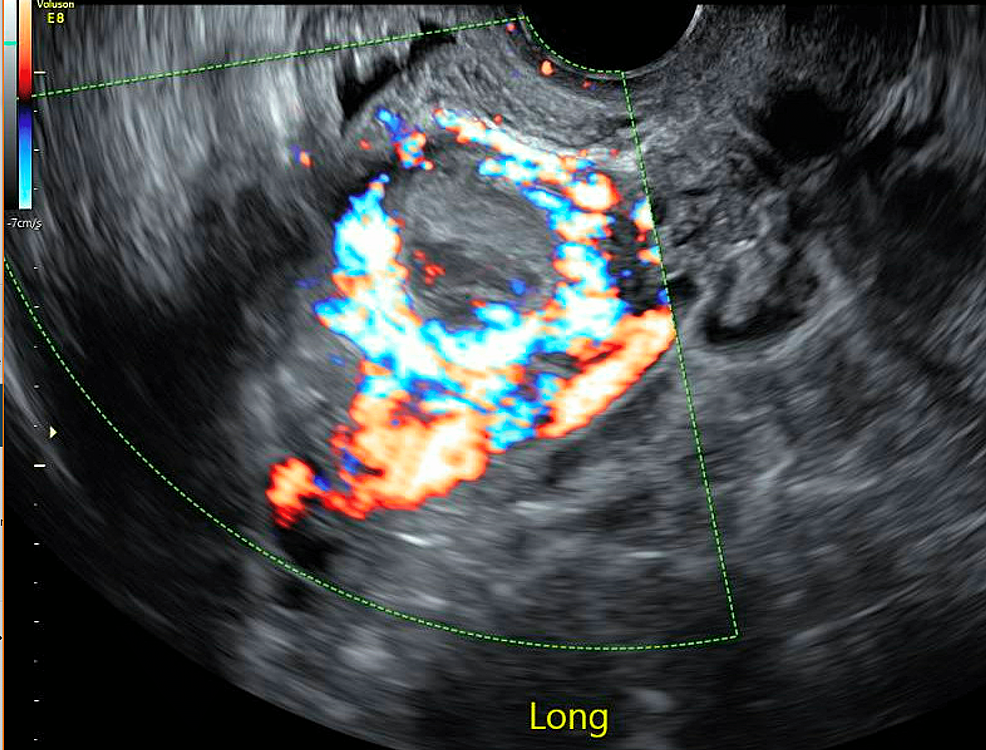 Sonography of Pelvic Masses Associated with Early Pregnancy | Radiology Key