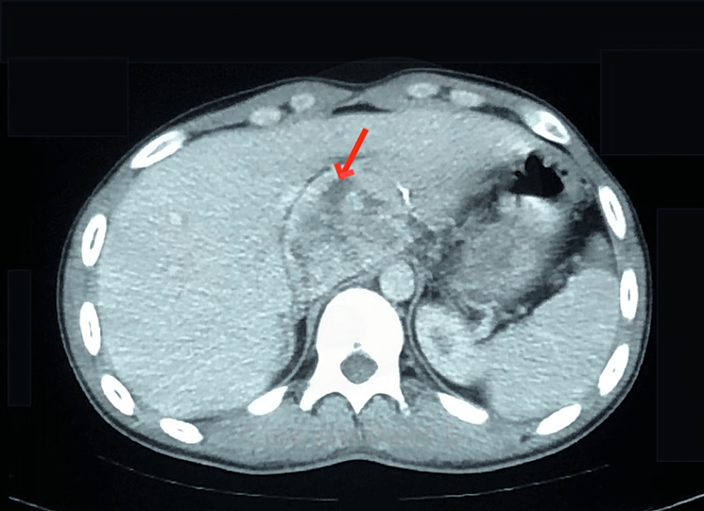 Pheochromocytoma Ct Scan