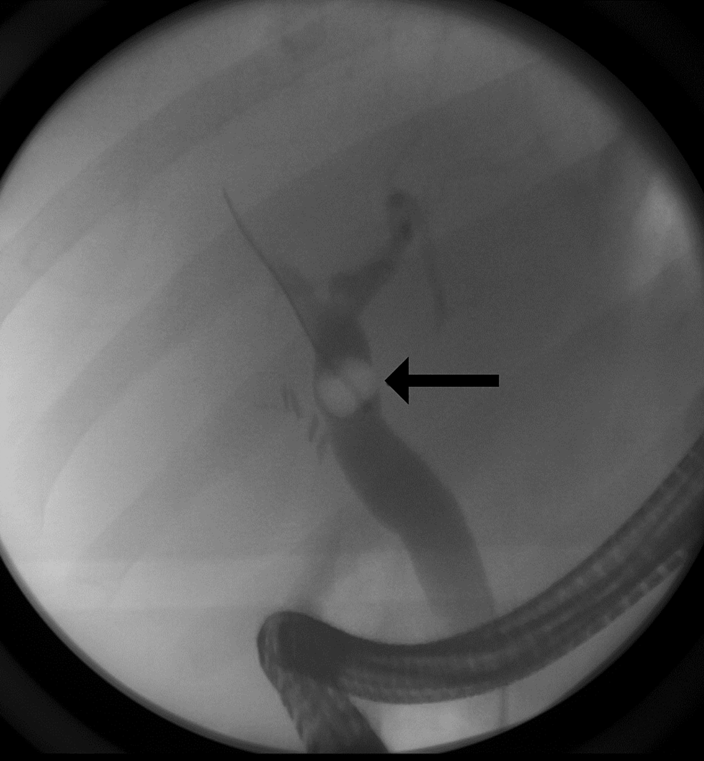 Cureus Gallstone Pancreatitis Post Laparoscopic Cholecystectomy A Case Report
