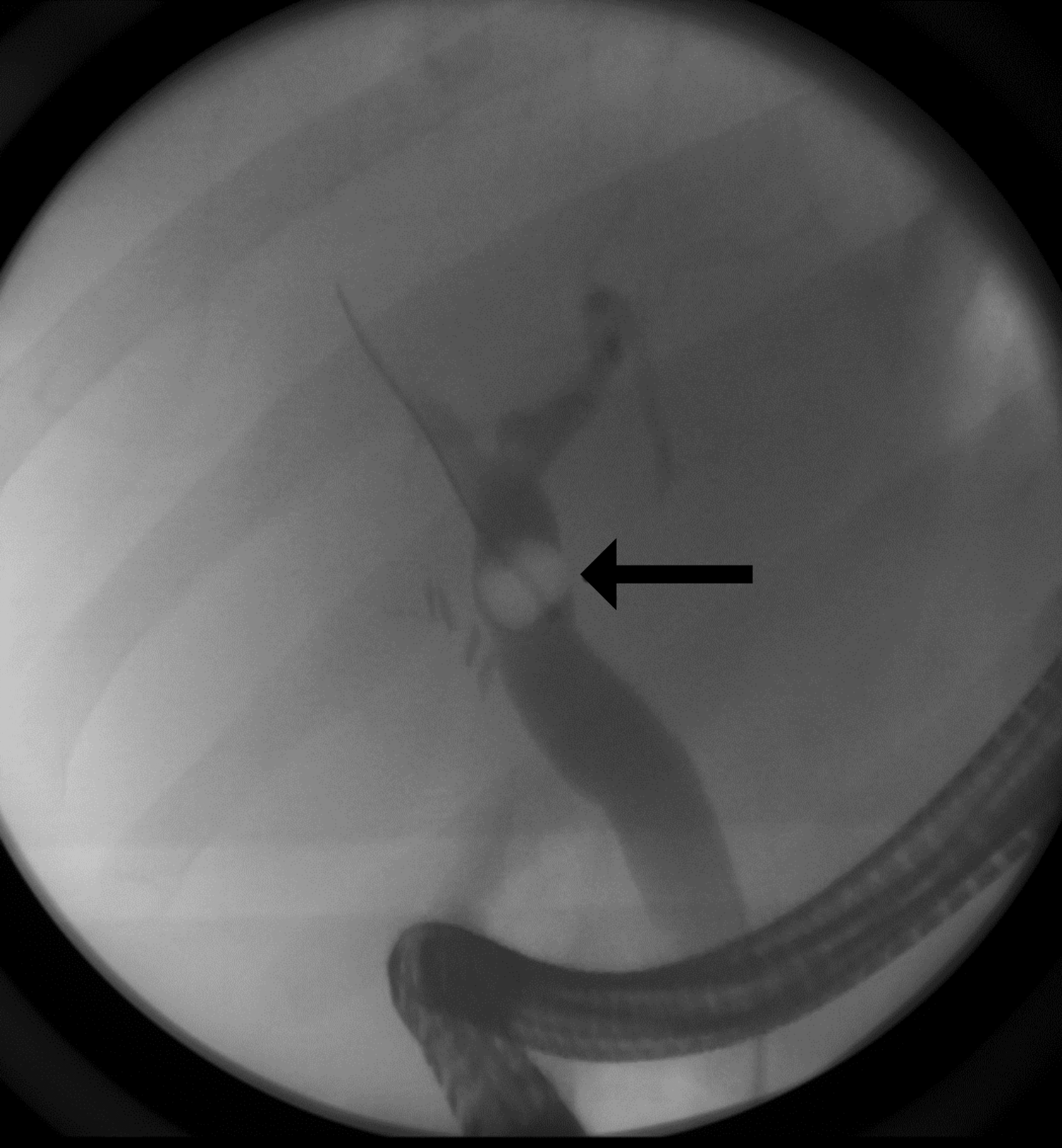 Cureus Gallstone Pancreatitis Post Laparoscopic Cholecystectomy A