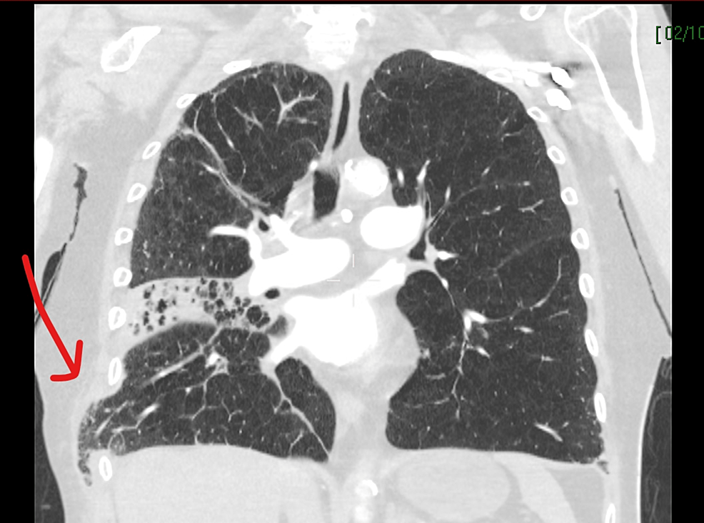 Cureus Lung Herniation as a Result of Cardiopulmonary Resuscitation