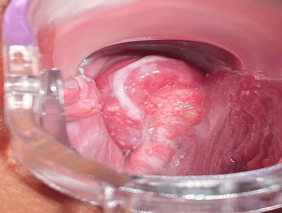 Cureus A Large Exophytic Tumor of the Cervix Causing Vaginal