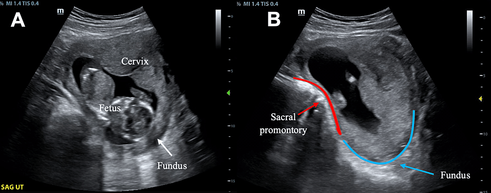 Cureus, Acute Urinary Retention in the First-trimester of Pregnancy: A  Case Report