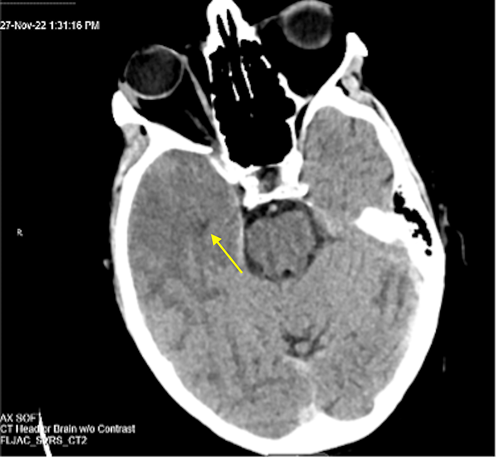 cureus-rapid-onset-temporal-encephalitis-with-negative-cerebrospinal