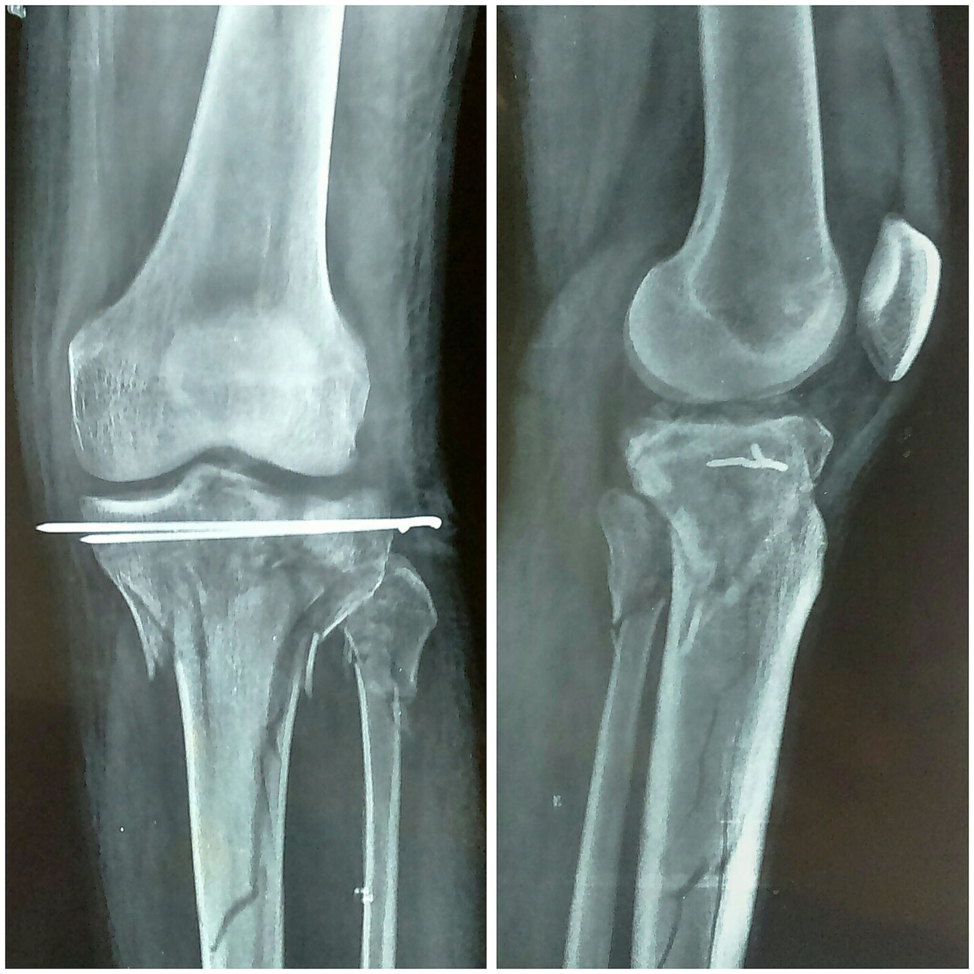 tibial plateau fracture swelling