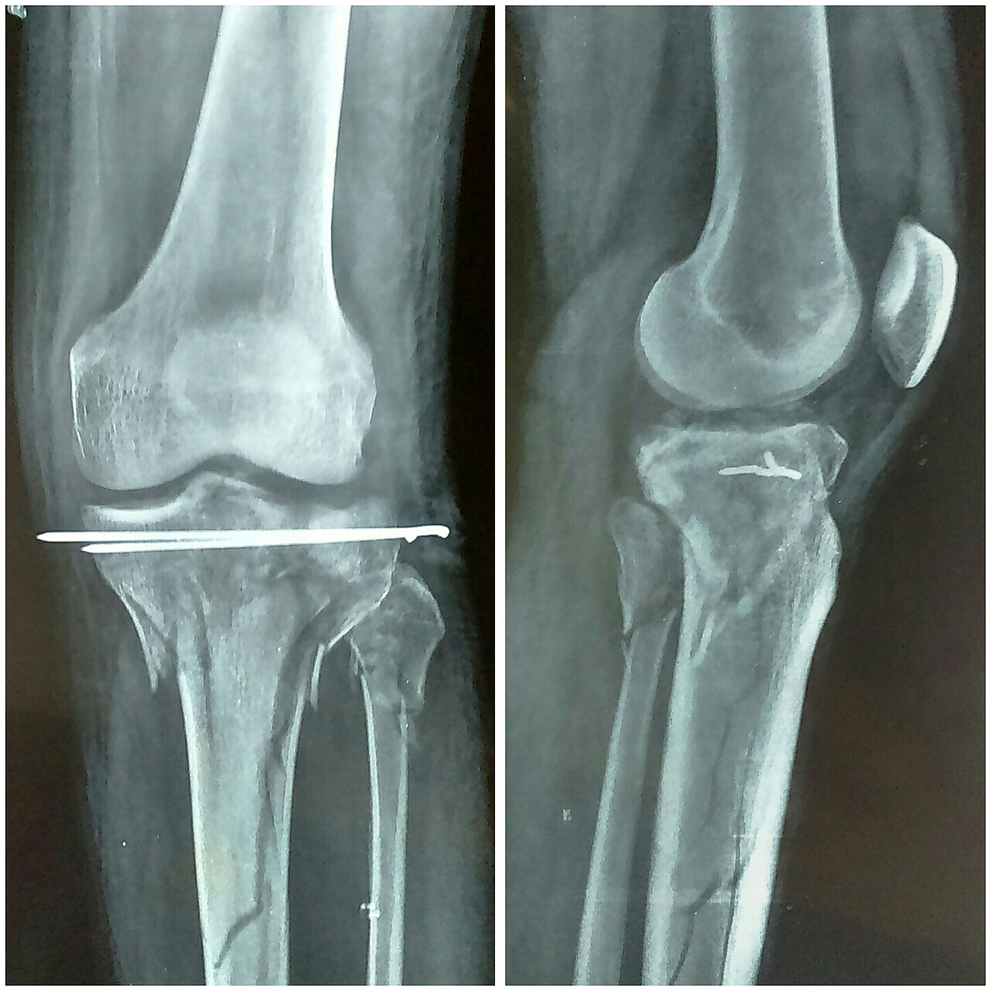 Lateral tibial plateau fracture treatment