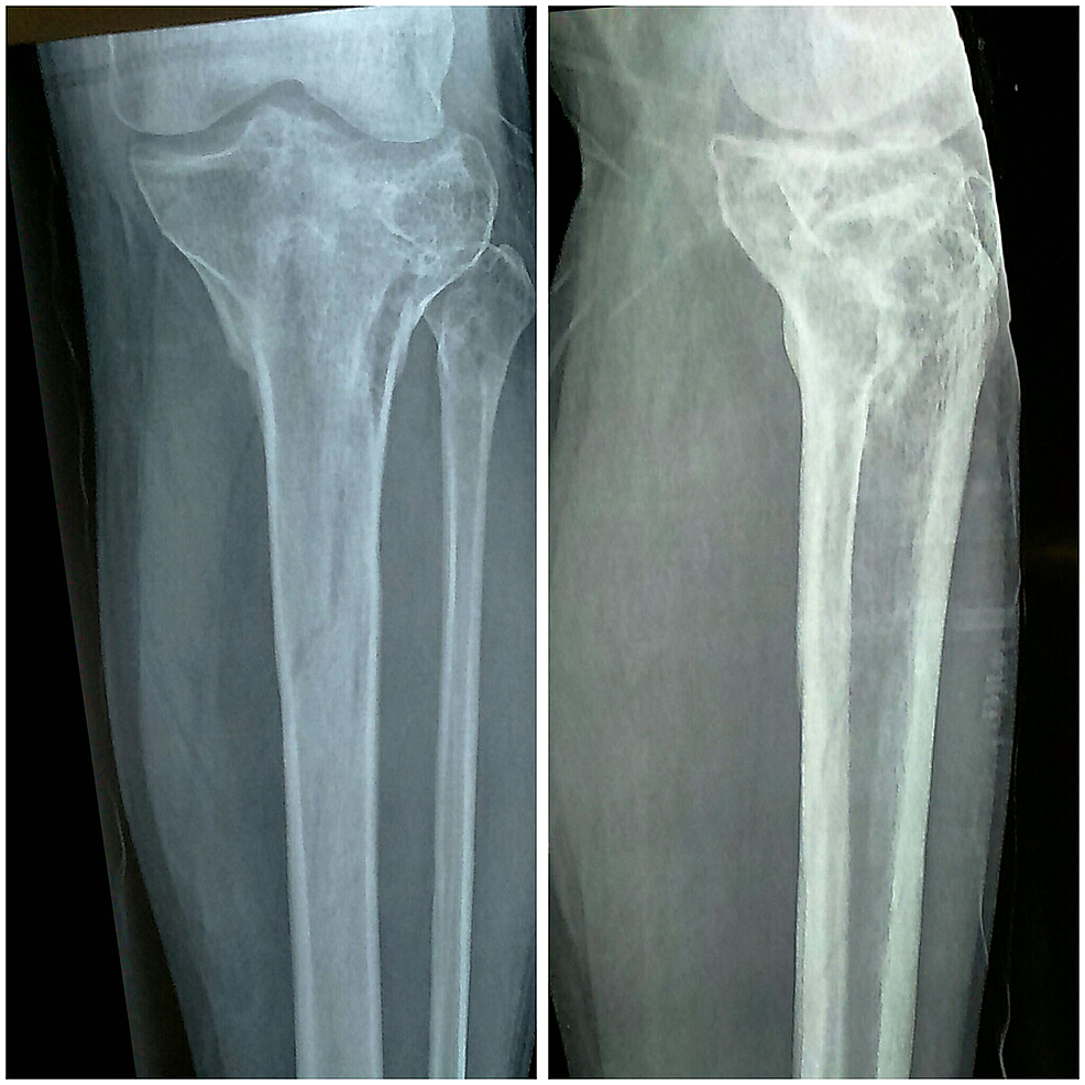 Minimally Invasive Treatment Of A Complex Tibial Plateau Fracture With Diaphyseal Extension In A